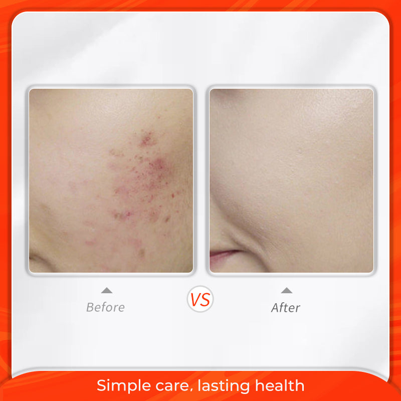 MeiYanQiong Centella Acne Repair Serum Oil Control and Acne Care Soothing and Repairing Skin